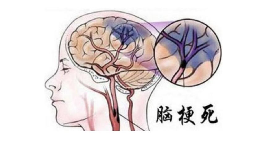 【健康科普】突发脑梗别发慌，记住这篇急救知识